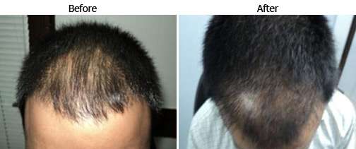 Pictures of Cost of hair transplantation in india 2