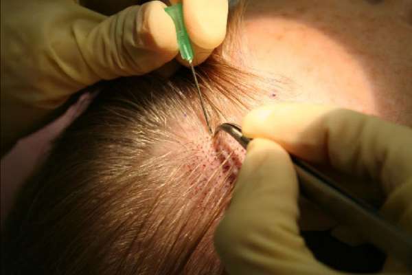 Pictures of Cost of hair transplantation in india 1