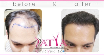 FUE Hair Transplant in Delhi FUE Hair Transplant Treatment in India